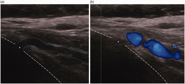 Endovascular coiling of large mastoid emissary vein causing pulsatile ...