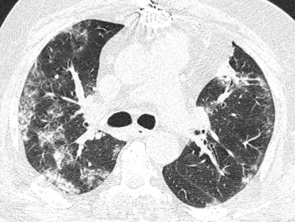 Image in a 64-year-old man who presented with fever since 2 days before CT examination with history of sternotomy and total CT-score of 14, who was admitted in intensive care unit. Axial thin-section unenhanced CT image shows bilateral mostly consolidation opacities.