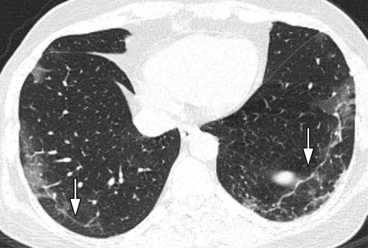 Images in a 52-year-old woman without underlying disease, who presented with fever, cough, and myalgia since 10 days before imaging with total CT-score of 8. (a) Axial thin-section CT image shows bilateral upper lobes ground glass opacities (arrows). (b) Linear opacities in both lower lobes (arrows). (c) Intralesional bronchial distortion (arrow).