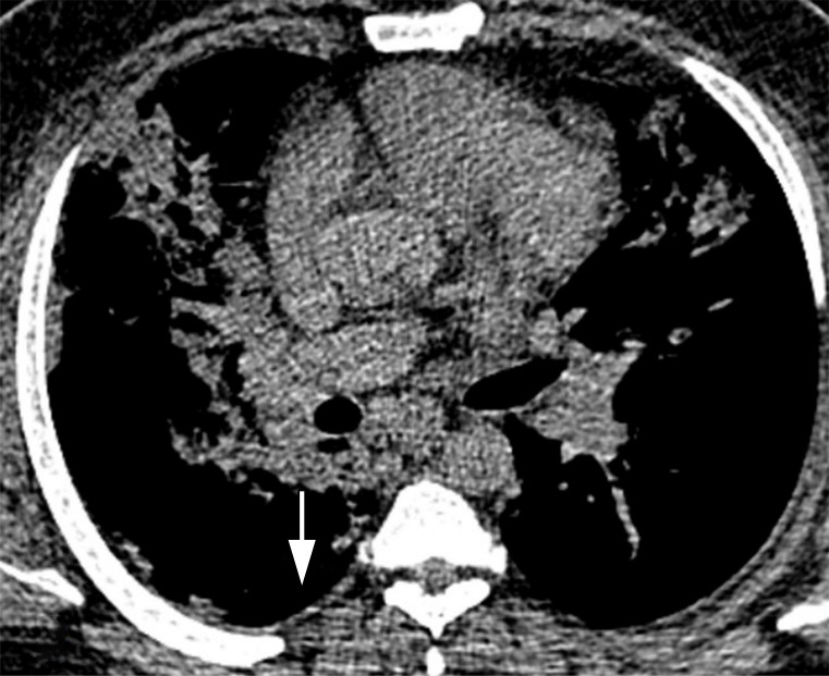 Images in a 43-year-old man who presented with fever, cough, and dyspnea 7 days before, without underlying disease, with total CT-score of 17, who died after a few days of intensive care unit admission. (a) Axial thin-section unenhanced CT image shows bilateral mostly consolidation opacities (arrows) with paracardiac involvement especially in right lung. (b) Right side trace plural effusion (arrow).