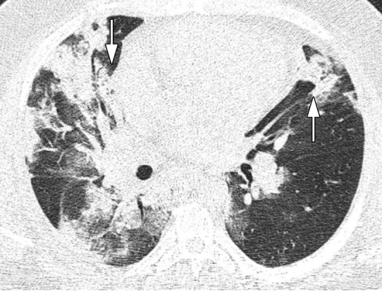 Images in a 43-year-old man who presented with fever, cough, and dyspnea 7 days before, without underlying disease, with total CT-score of 17, who died after a few days of intensive care unit admission. (a) Axial thin-section unenhanced CT image shows bilateral mostly consolidation opacities (arrows) with paracardiac involvement especially in right lung. (b) Right side trace plural effusion (arrow).