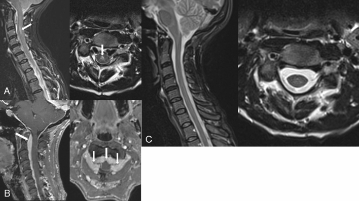 Case report of a cervical myelomalacia caused by a thoracolumbar ...