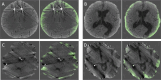 (A–D) Images show visualization of false-positive predictions,
which are frequently made without the ranker. Green indicates the model
predictions. These axial CT images obtained without contrast material
administration are from the validation set.