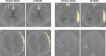 (A–D) Images show visualization of model predictions on the
validation set using the baseline and semi-supervised (SS) models. Red is
the reference standard label, green is the model’s positive
prediction, and yellow is the overlap. These are axial CT images obtained
without contrast material administration.