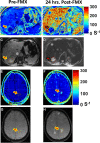 Transverse relaxation rate (R*2) maps computed before
ferumoxytol (FMX) and 24 hours after FMX administration in a representative
participant with (A, B) liver and (E, F) brain metastases (arrows).
R*2-weighted anatomic images on which radiologists drew tumor regions
of interest (arrows) are shown for (C, D) liver and (G, H) brain. The color
scale, from blue to red, indicates increasing values of R*2 (in
seconds−1).