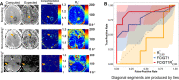 Performance of discriminators for classification of responding tumor
(RT) versus nonresponding tumor (NRT) brain metastases. (A) Qualitative
illustration of maps generated for three tumors with different responses to
liposomal irinotecan treatment. Images depict a responding tumor (top row),
a tumor that first responded then progressed (middle row), and a tumor that
progressed (bottom row). For each tumor, computed and model-expected
R1-weighted post-FMX MR images, their ratio, and reference transverse
relaxation rate (R*2) maps are shown. Radiologist-drawn tumor
contours are indicated by arrows. (B) The receiver operating characteristic
plots of three putative discriminators of RT (nine lesions) versus NRT (10
lesions). FCIGT1 = fraction of pixels within a tumor volume of interest with
compartmentation index greater than 1, FCIGT1R*2,90 = fraction of
pixels within a tumor volume of interest with compartmentation index greater
than 1 and R*2 in the 90th and higher percentile.