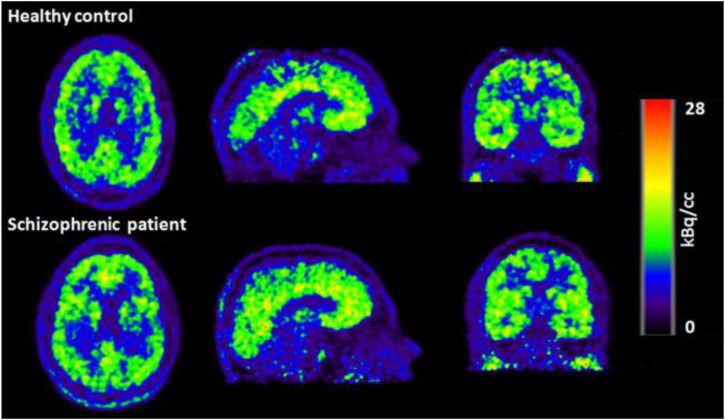 Simultaneous Electroencephalography Functional Magnetic Resonance Imaging For Assessment Of