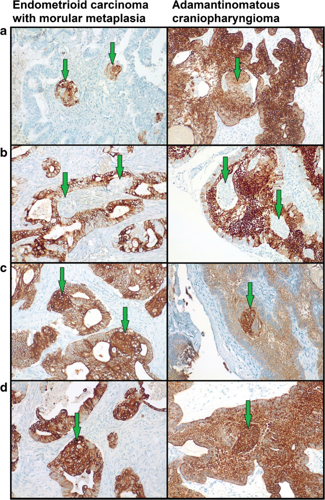 Does Endometrial Morular Metaplasia Represent Odontogenic 