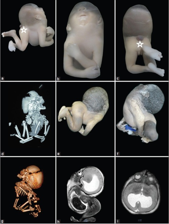 Iniencephaly: Radiological and pathological features of a series of ...