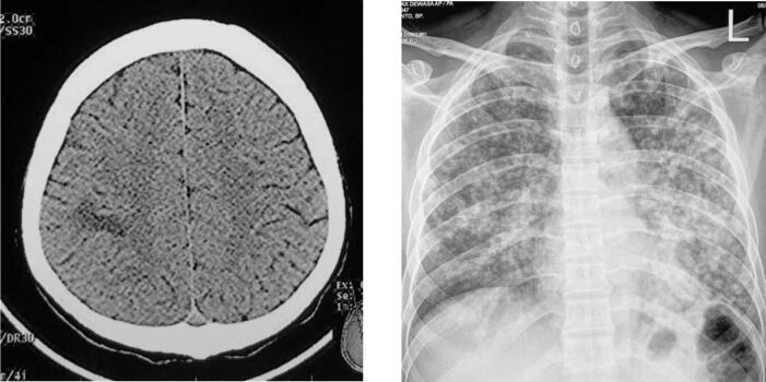 encephalitis-due-to-miliary-tuberculosis-in-a-patient-with-human