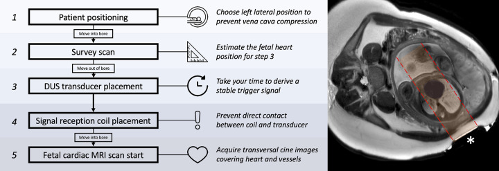 Fetal cardiac MRI workflow used in this study. An axial single-shot T2-weighted turbo spin-echo planning or survey image at fetal heart level (right) shows the Doppler US (DUS) transducer (*) placed on the maternal abdomen. The acoustic window (highlighted in red) is correctly positioned toward the fetal heart, providing a stable trigger signal.