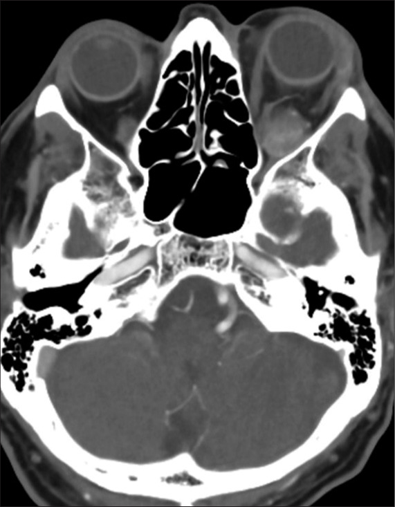 Thrombosed orbital varix of the inferior ophthalmic vein: A rare cause ...