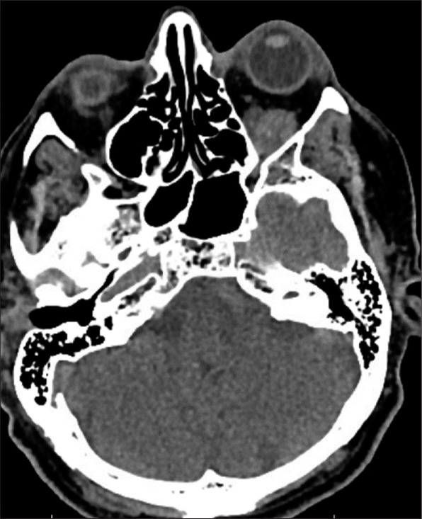 Thrombosed orbital varix of the inferior ophthalmic vein: A rare cause ...