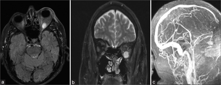 Thrombosed orbital varix of the inferior ophthalmic vein: A rare cause ...