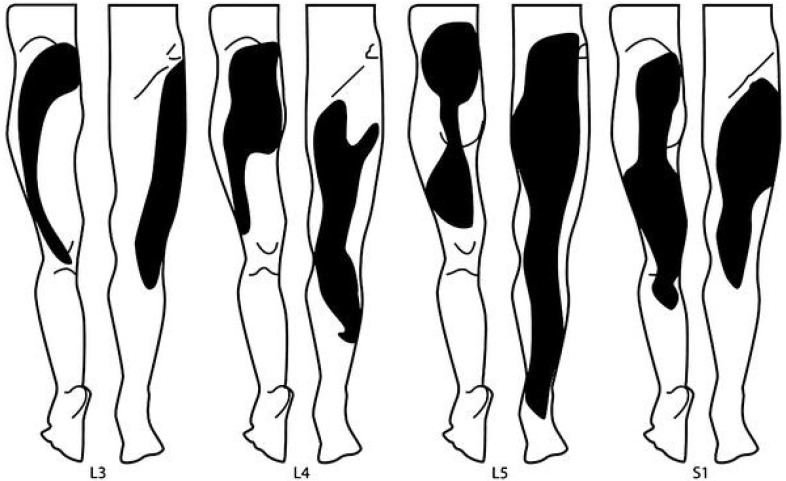 Defining the Patient with Lumbar Discogenic Pain: Real-World ...