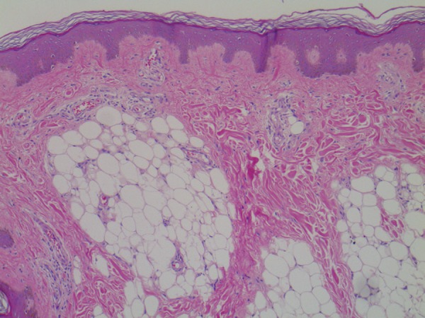 Nevus lipomatosus cutaneous superficialis - PMC