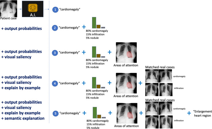 Different modalities for model interpretation. For example, an artificial intelligence (AI) system that predicts the condition from a patient’s chest radiograph is shown. From top to bottom, interpretability information is added to the decision: (1) no interpretability information, (2) added output probabilities, (3) added visual saliency information describing areas of the image driving the prediction, (4) added matched real cases used during training of the AI solution influencing the prediction (ie, influential functions), and (5) added computer-generated semantic explanation.