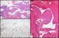 Histopathology analysis of resected IJV lesion using H&E stain