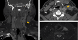 Preoperative imaging of IJVM with CT and MRI views showing hyperintense lesion in T2