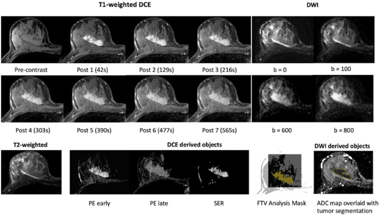 Example MRI data shared through the BMMR2 challenge. All images were from the same individual (female, age 57 years) at pretreatment (T0). T1-weighted dynamic contrast-enhanced (DCE) images, diffusion-weighted images (DWI), and T2-weighted images are original images. Percentage enhancement (PE) early was derived from precontrast and post 2 (129 seconds after the administration of contrast agent). PE late was derived from precontrast and post 6 (477 seconds after the administration of contrast agent). Signal enhancement ratio (SER) was derived from precontrast, post 2, and post 6. Tumor segmentations were provided as image masks in DCE images and manually defined contours in DWI. ADC = apparent diffusion coefficient, BMMR2 = Breast Multiparametric MRI for prediction of neoadjuvant chemotherapy Response, FTV = functional tumor volume.