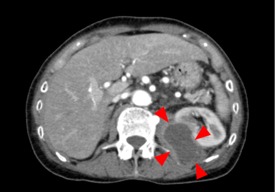 Perirenal Abscess in a Patient with Rheumatoid Arthritis - PMC