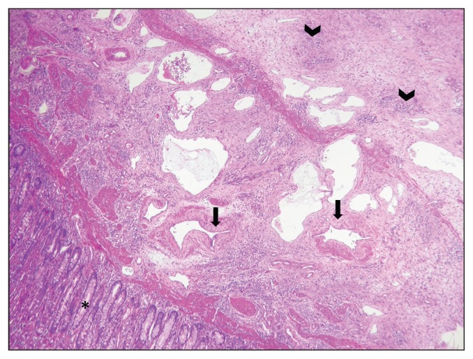 Cecal vascular hamartoma causing recurrent colic in an Arabian mare - PMC