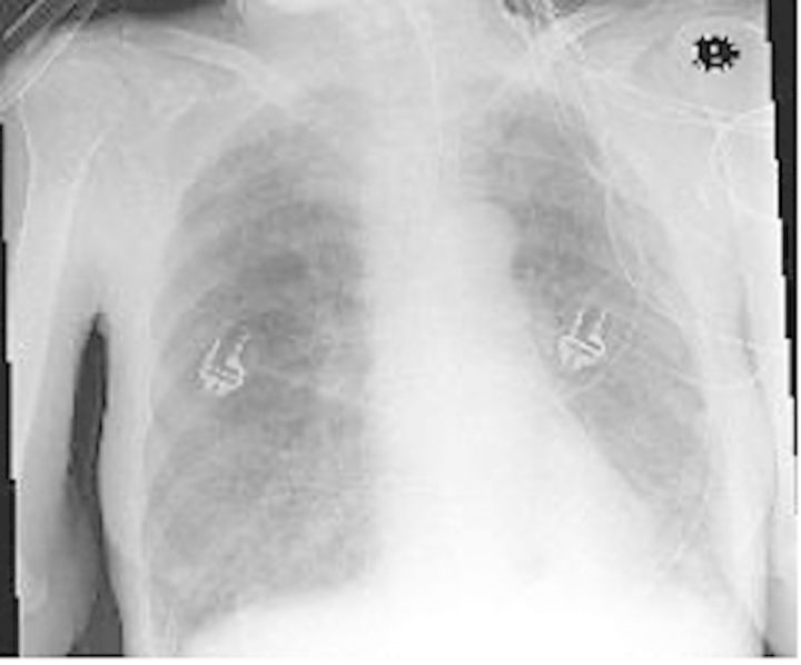 Candida Pneumonia in Intensive Care Unit? - PMC