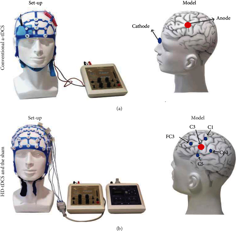 Clinical Comparison between HD-tDCS and tDCS for Improving Upper Limb ...