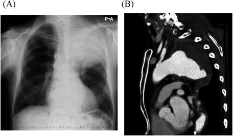 Fig. 1 (A) Chest radiography showing a huge thoracic aortic aneurysm in the upper left lung field. (B) Preoperative, contrast-enhanced computed tomography showing a giant ruptured thoracic aortic aneurysm close to the left subclavian artery.