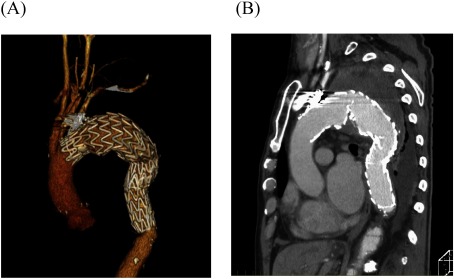 Fig. 3 (A, B) Postoperative, contrast-enhanced computed tomography showing the stent graft covering the segment from the left subclavian artery to the level of the ninth thoracic vertebra and completely shielding the aneurysm.