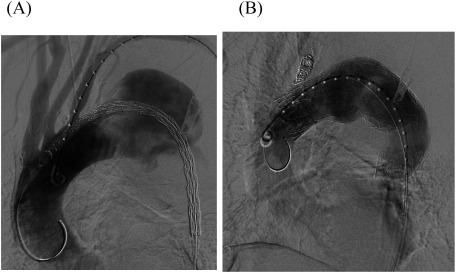 Fig. 2 (A) Intraoperative angiography showing a thoracic aortic aneurysm close to the left subclavian artery (LSA). The need for LSA coverage is apparent. (B) The proximal stent was 45 mm in diameter and 200 mm long; the distal stent was 45 mm in diameter and 150 mm long. LSA coverage was required to achieve an adequate proximal seal. Additionally, LSA coil occlusion was performed.