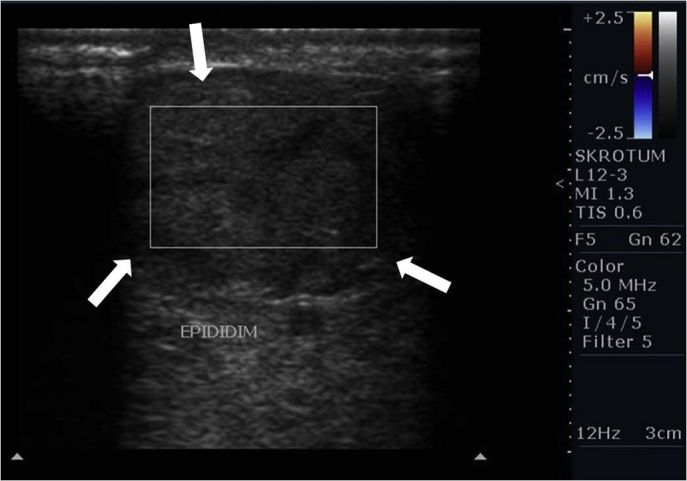 Untreated Isolated Torsion of the Epididymis in an Adolescent - PMC