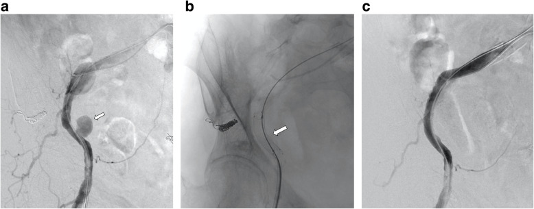 Emergency endovascular treatment using a Viabahn stent graft for upper ...