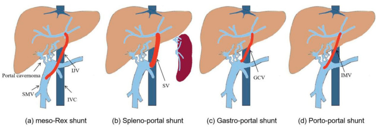 Rex Shunt for Extra-Hepatic Portal Venous Obstruction in Children - PMC