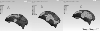 Figure 12. Von Mises equivalent stresses (MPa) on the articular disc at HA1, HA2, and HA3.