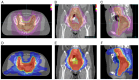Figure 1. Representative dose distribution maps for HT and IMRT plans. Dose distribution maps for the HT plan at different axial, coronal and sagittal slices. (A) Axial dose distribution, showing cove...