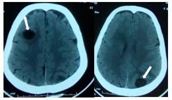 Figure 1. TDM cérébrale coupe axiale : kystes hydatiquescérébraux multiples (frontal droit et pariétal postérieur gauche)