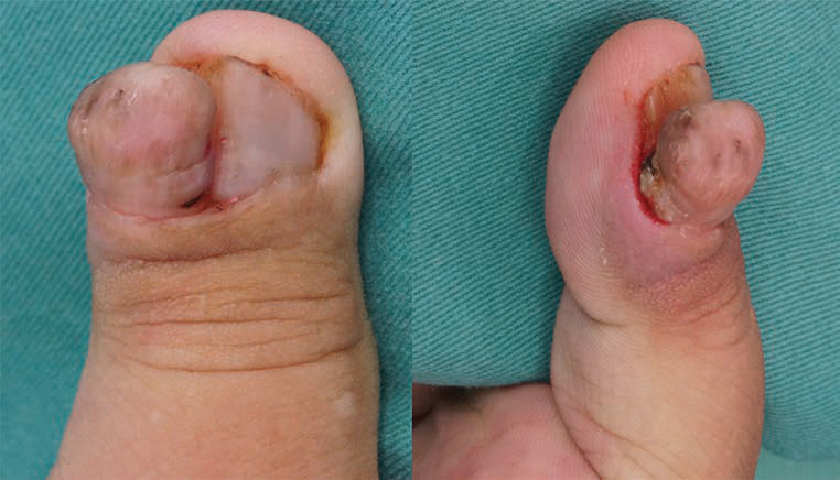 Symptomatic Periungual Fibroma of the Hand - PMC