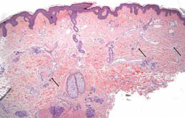 A case of acquired tufted angioma in adulthood - PMC