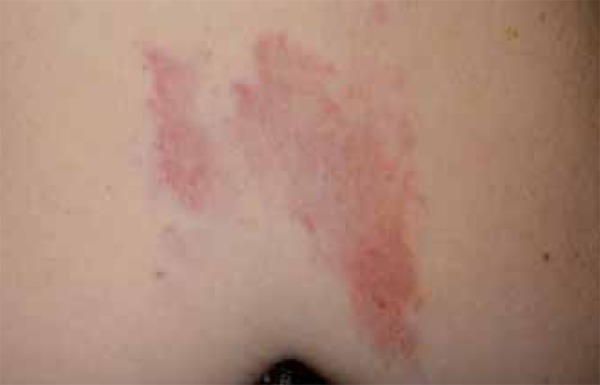 A case of acquired tufted angioma in adulthood - PMC