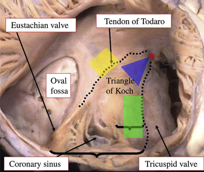 Atrioventricular junctional ablation: The good, the bad, the better - PMC