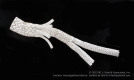 Gore TAMBE thoracoabdominal device