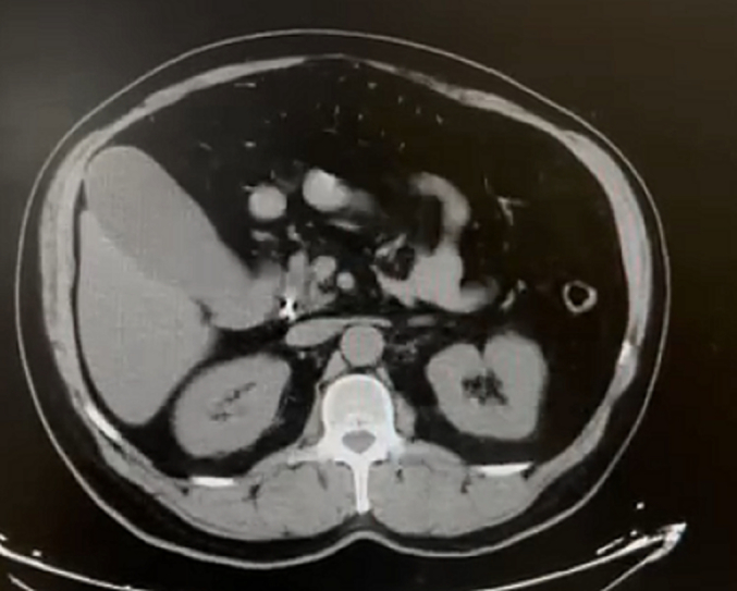 Challenges In Diagnosing And Managing Cystic Duct Carcinoma A Case challenges-in-diagnosing-and-managing-cystic-duct-carcinoma-a-case