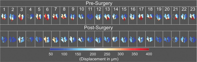 Peak displacement maps for the brainstem and cerebellum before and after surgery for all participants evaluated in this study. The brainstem peak displacement maps for participants 4 and 21 could not be acquired because of limited image quality; the outlines of the brainstem shown for these participants were acquired with sagittal T2-weighted multisection turbo spin-echo imaging (repetition time msec/echo time msec, 3500/106).