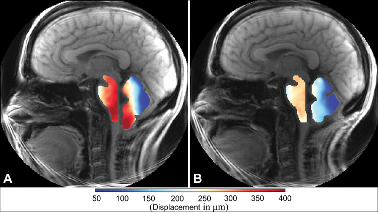 Displacement encoding with stimulated echoes magnitude images with overlays of peak displacement maps for the brainstem and cerebellum in participant 6, a 42-year-old woman with Chiari malformation type I. Images were obtained (A) before surgery and (B) after surgery. In each image, the map for the brainstem is on the left and the map for the cerebellum is on the right.