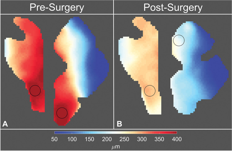 Eulerian peak displacement maps of the brainstem and cerebellum in participant 6, a 42-year-old woman with Chiari malformation type I. Images were obtained (A) before surgery and (B) after surgery. The circles on the displacement maps are the two regions of interest with maximum peak displacement.