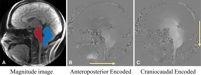 Examples of presurgical midsagittal plane displacement encoding with stimulated echoes MRI sets (each image set contains 22 frames obtained over the cardiac cycle) in participant 6, a 42-year-old woman with Chiari malformation type I. (A) Magnitude reconstruction (from cardiac frame 1/22) shows brainstem (red) and cerebellar mask (blue). (B) Phase image (from cardiac frame 15/22) with displacement encoded in the anteroposterior direction (arrow). (C) Phase image (from cardiac frame 15/22) with displacement encoded in the craniocaudal direction (arrow). B and C demonstrate anteroposterior and craniocaudal displacement from the frames with the peak motion. Bright pixels indicate motion to the right in B and in the caudal direction in C. No contrast agent was used in the study.