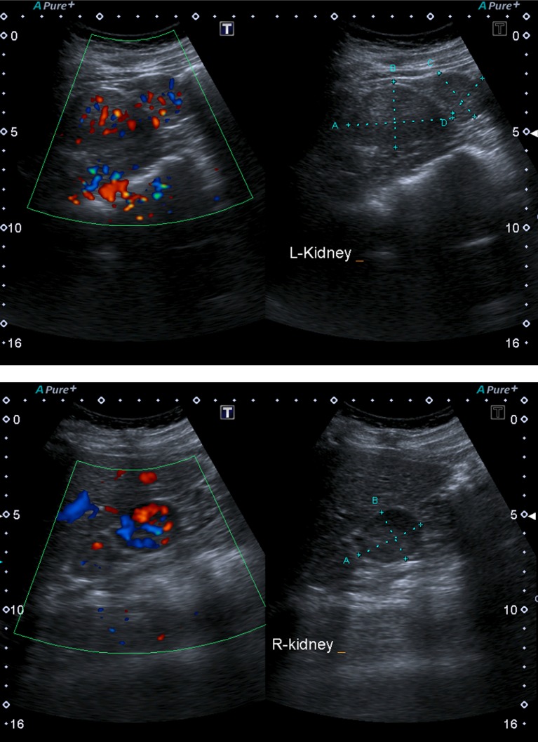 Persistent fetal lobulation of kidney mimicking renal tumour - PMC