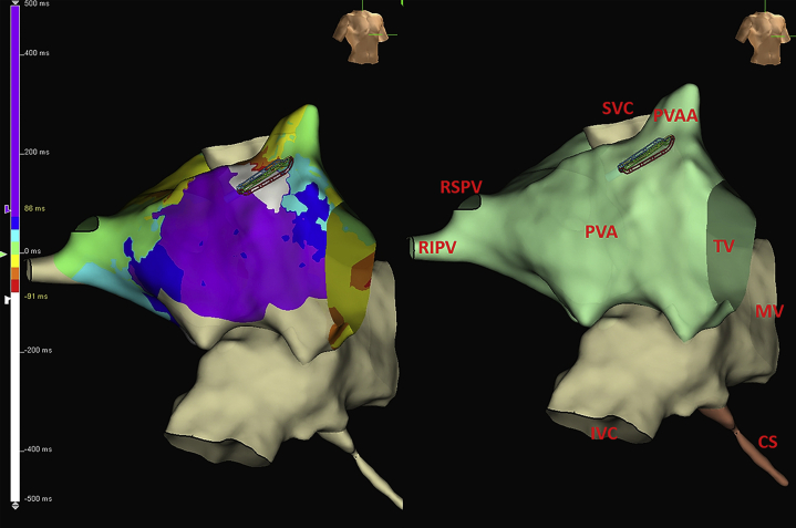 Uncovering “bipolar Blindness” With High-density Orthogonal Mapping At 