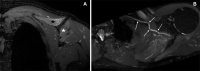 Patient 2: A 44-year-old man with Parsonage-Turner syndrome that developed 18 days following the second dose of the Moderna (mRNA-1273)
COVID-19 vaccine. (A) Coronal T2-weighted fat-suppressed fast-spin echo (FSE) image 5 weeks after symptom onset demonstrates denervation edema pattern
of the supraspinatus (black star) and infraspinatus (white star) muscles. (B) Oblique axial curved multiplanar reformatted T2-weighted fat suppressed FSE image
demonstrates four severe intrinsic constrictions (arrows) of the suprascapular nerve.